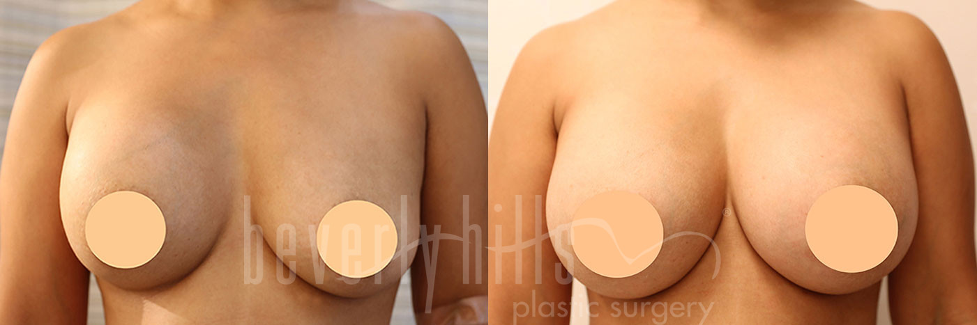 Breast Implant Exchange Patient 04 Before & After