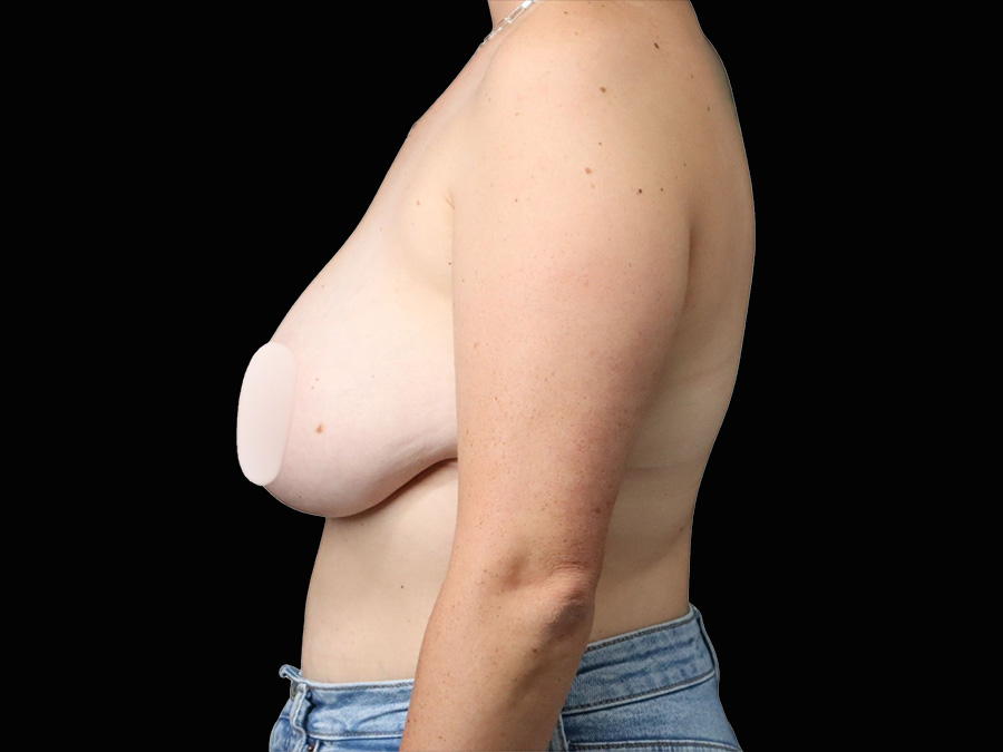 Case--2982 | Before Breast Reduction 3
