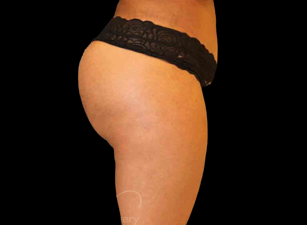 Case--7064 | After Body