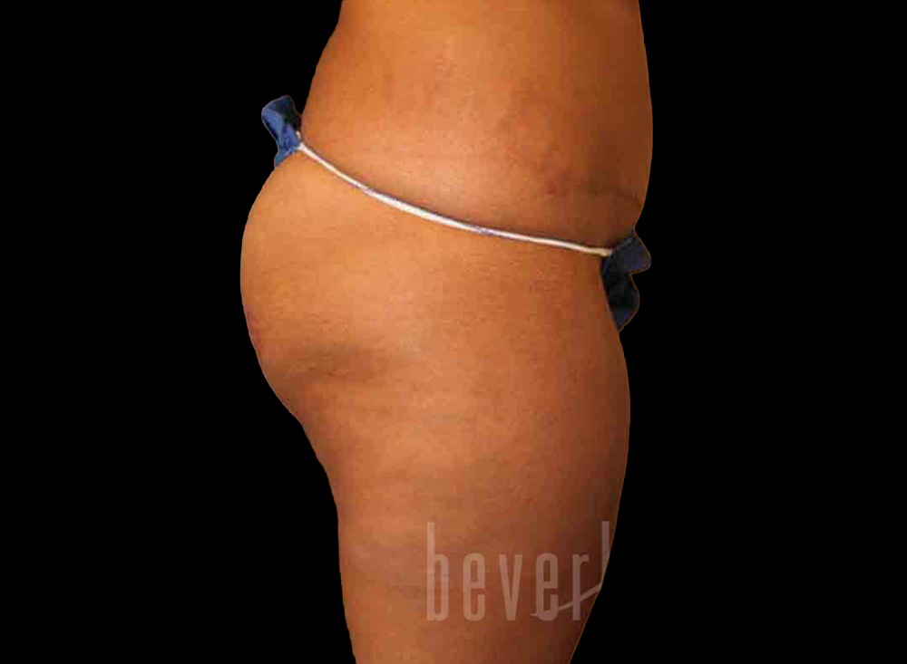 Case--7064 | Before Body