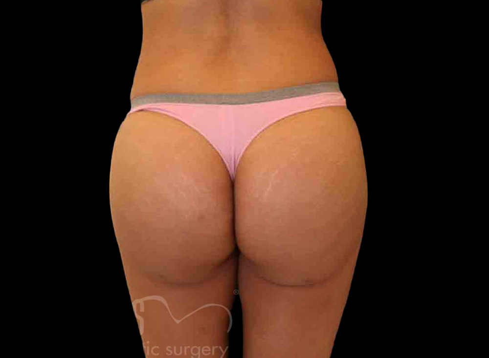 Case--4460 | After Body