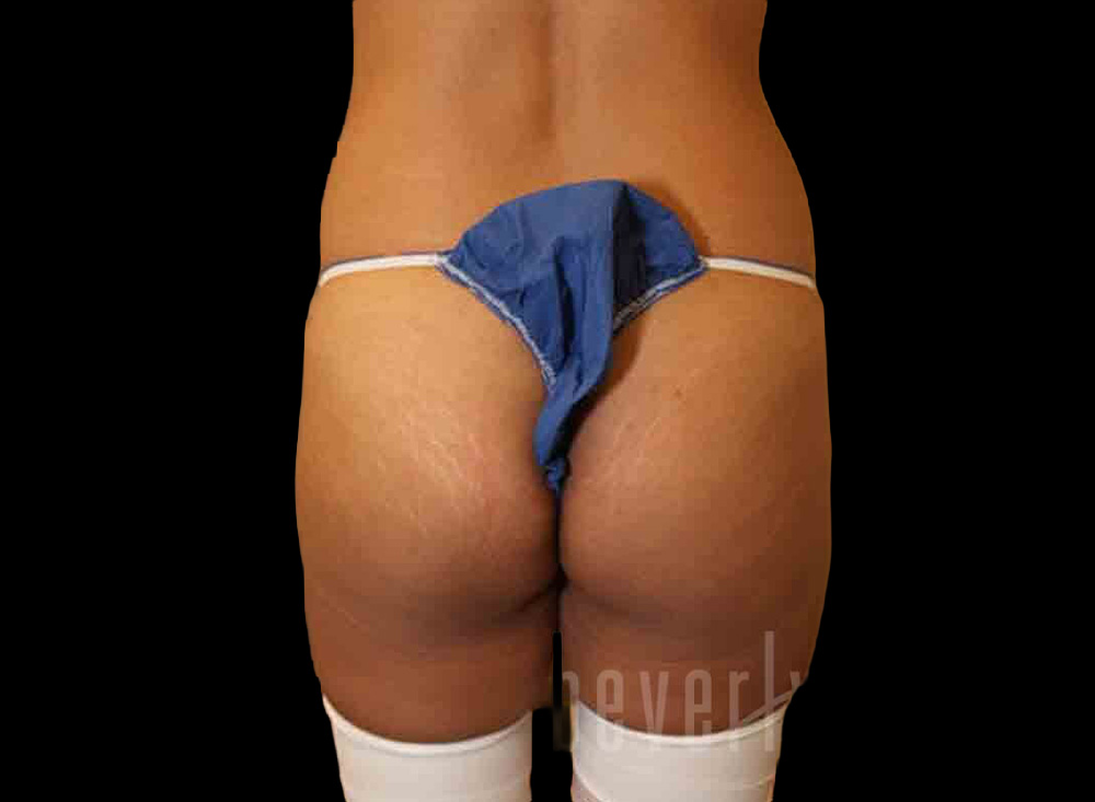 Case--4460 | Before Body