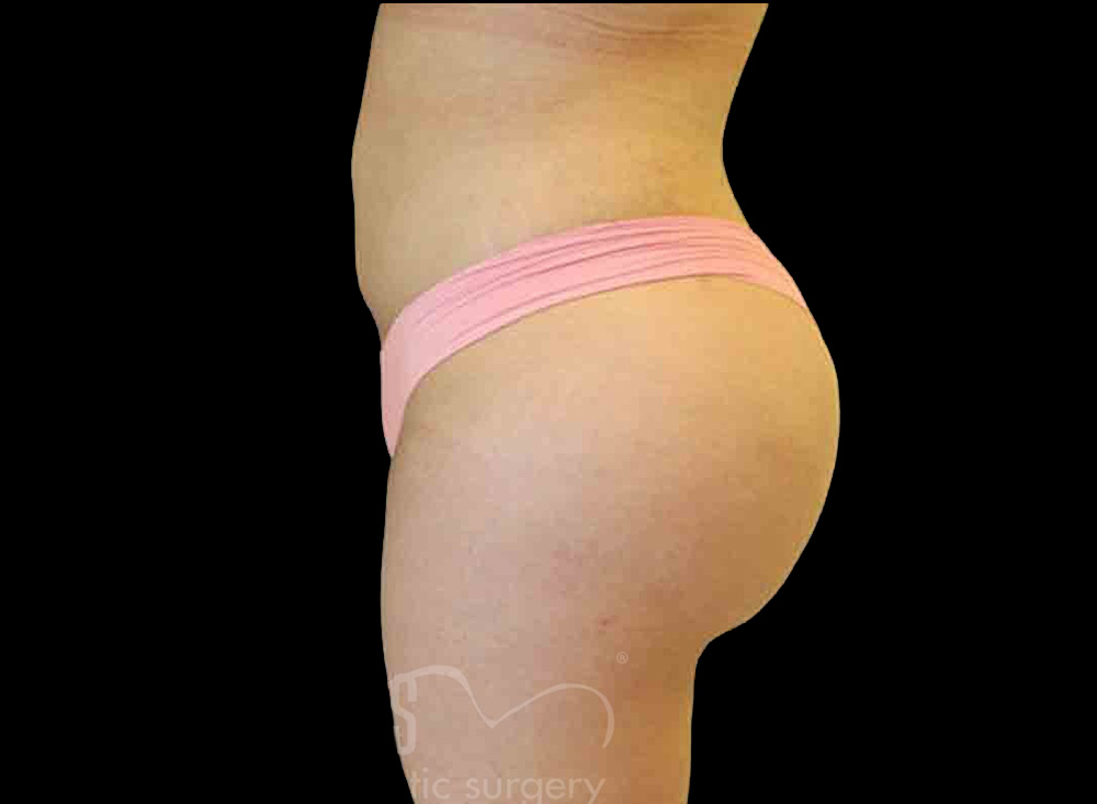 Case--8698 | After Body