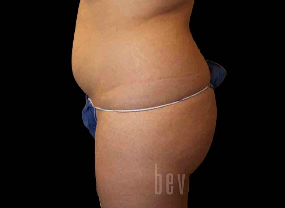 Case--8698 | Before Body