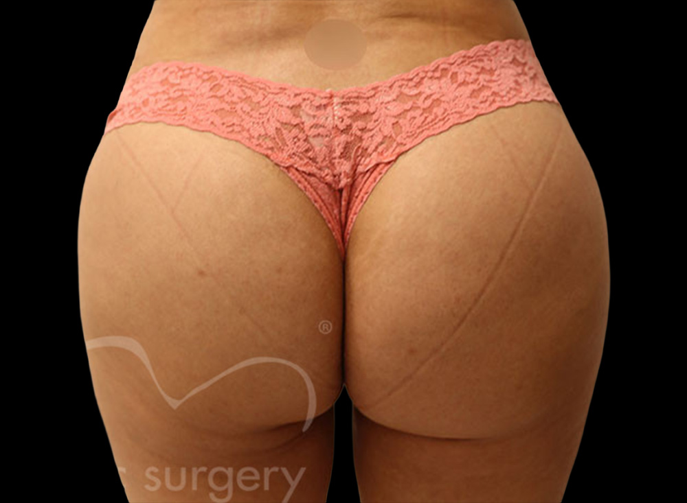 Case--1803 | After Body