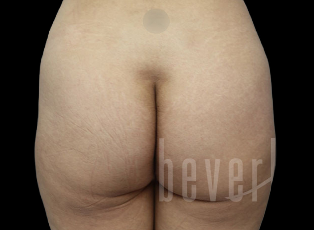 Case--1803 | Before Body