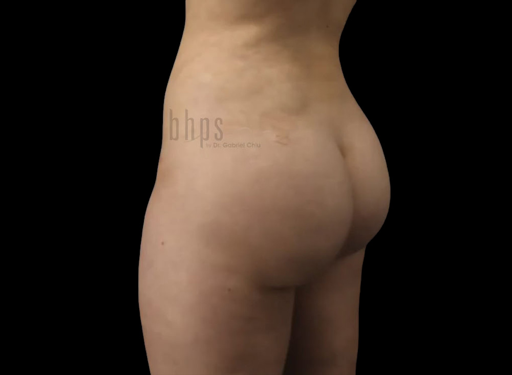 Case--3367 | After Body