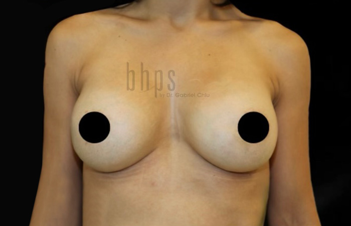 Case--7695 | After Breast