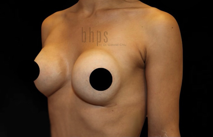 Case--7695 | Before Capsulectomy 2