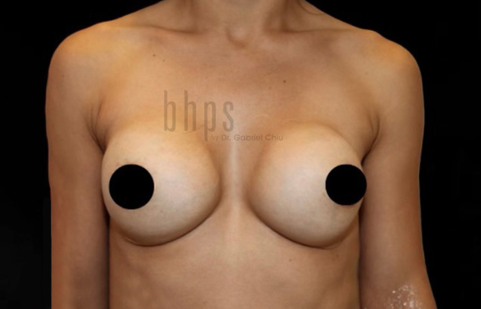 Case--7695 | Before Breast