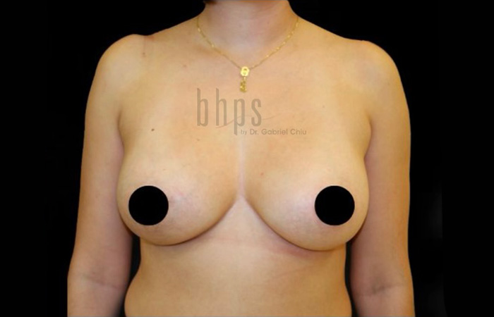 Case--4778 | After Breast