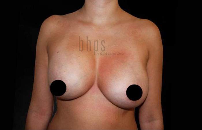 Case--4778 | Before Breast
