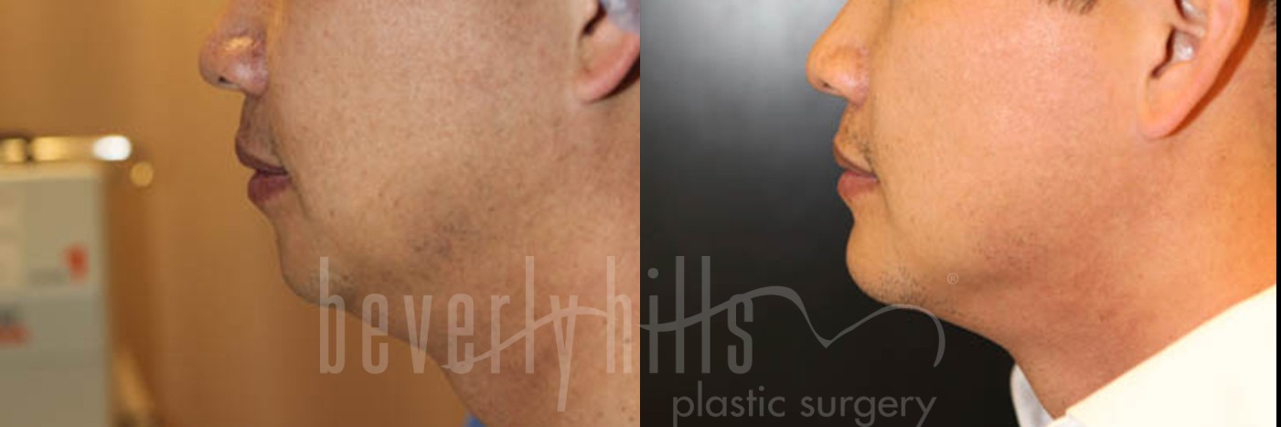 Chin Augmentation Patient 01 Before & After