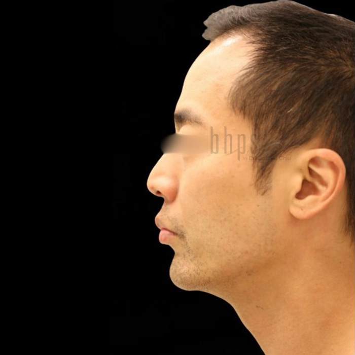 Case--8849 | After Chin Augmentation