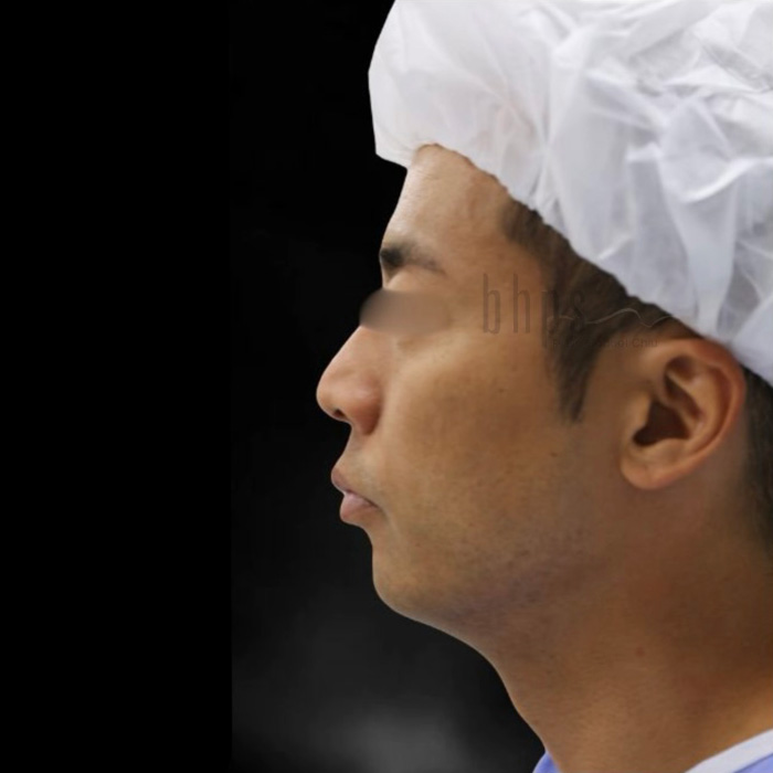 Case--8849 | Before Chin Augmentation