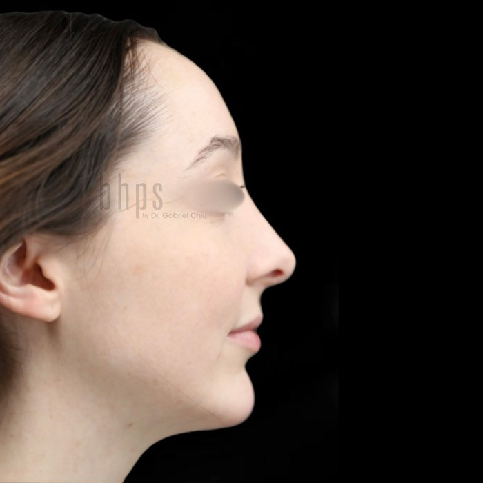 Case--1730 | After Chin Augmentation 2