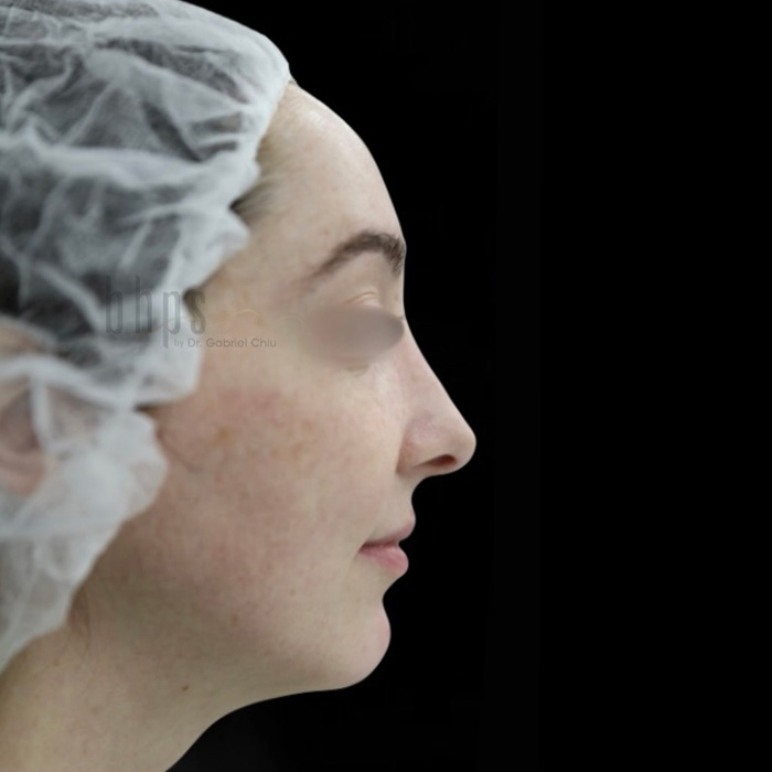 Case--1730 | Before Chin Augmentation 2