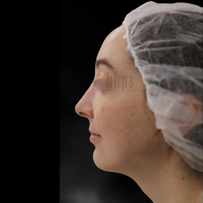 Chin and Cheek Augmentation Patient Before - 2