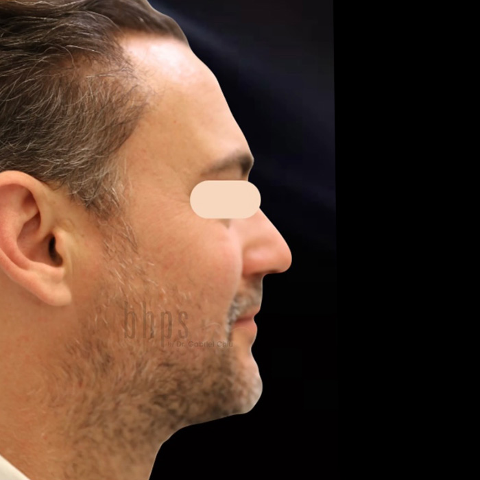 Case--2235 | After Chin Augmentation 2