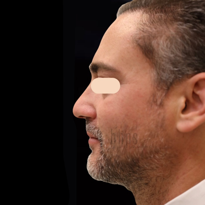 Chin and Cheek Augmentation Patient After - 1