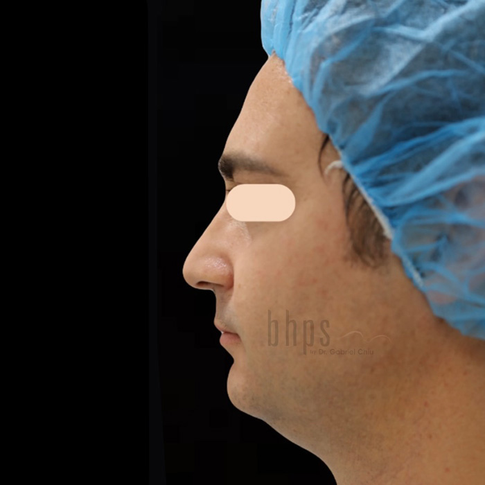 Chin and Cheek Augmentation Patient Before - 1
