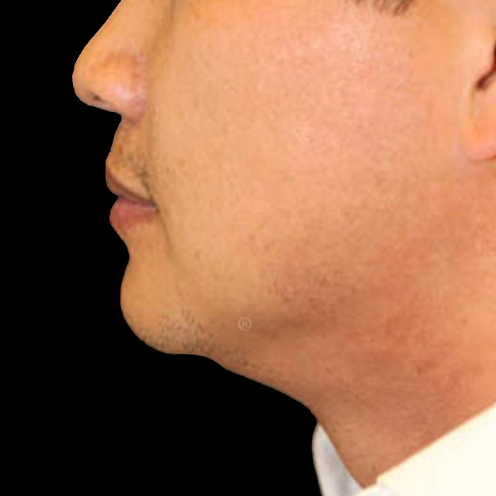 Case--4618 | After Face