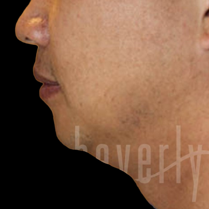 Case--4618 | Before Face