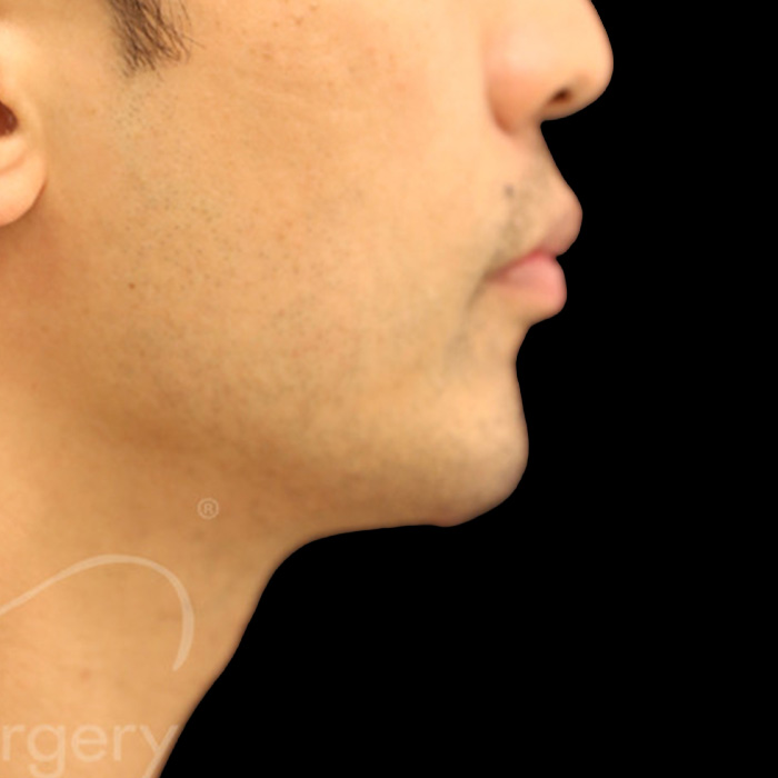 Case--7985 | After Face