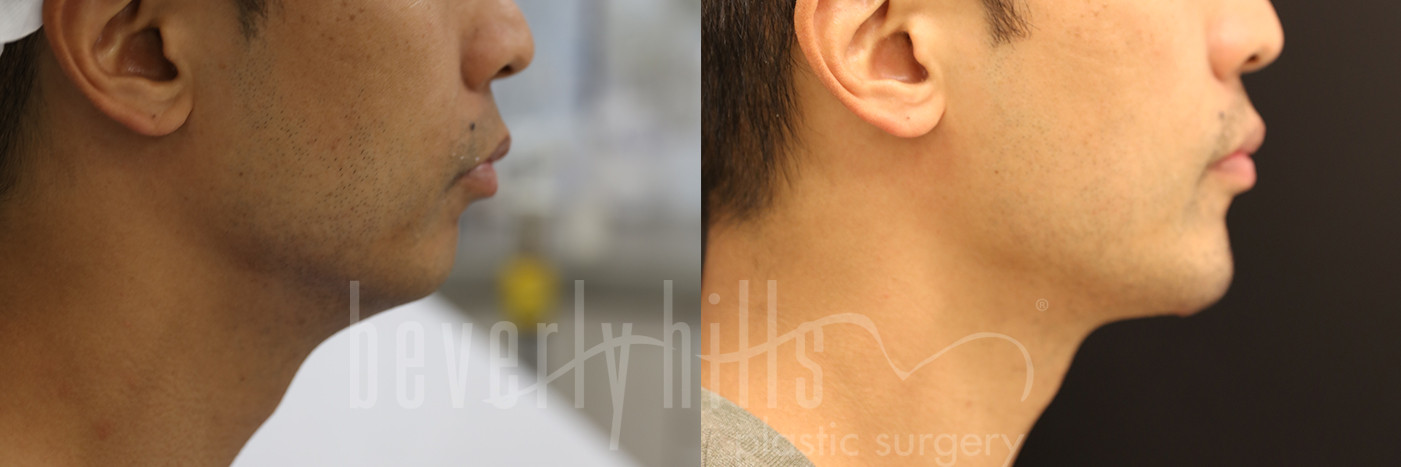 Chin Augmentation Patient 02 Before & After
