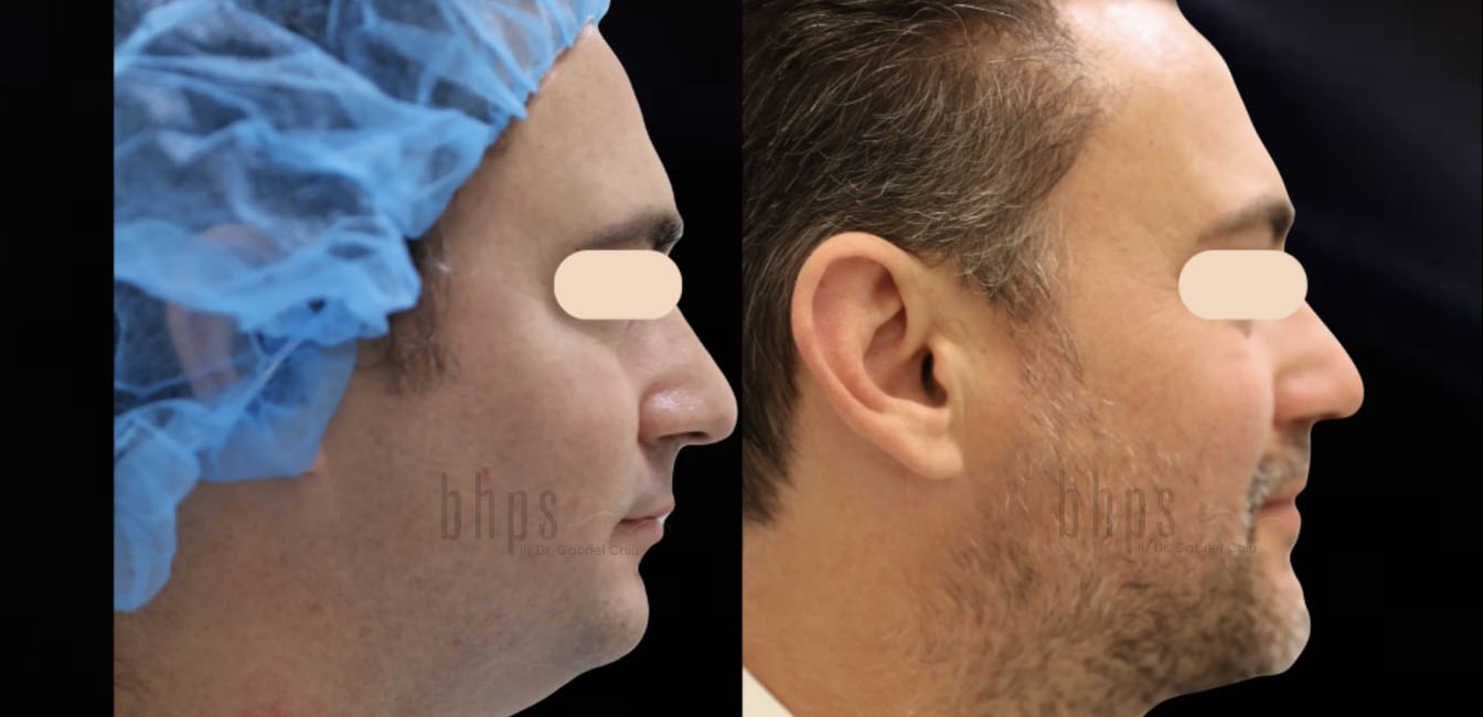 Chin Implants Patient 01 Before & After