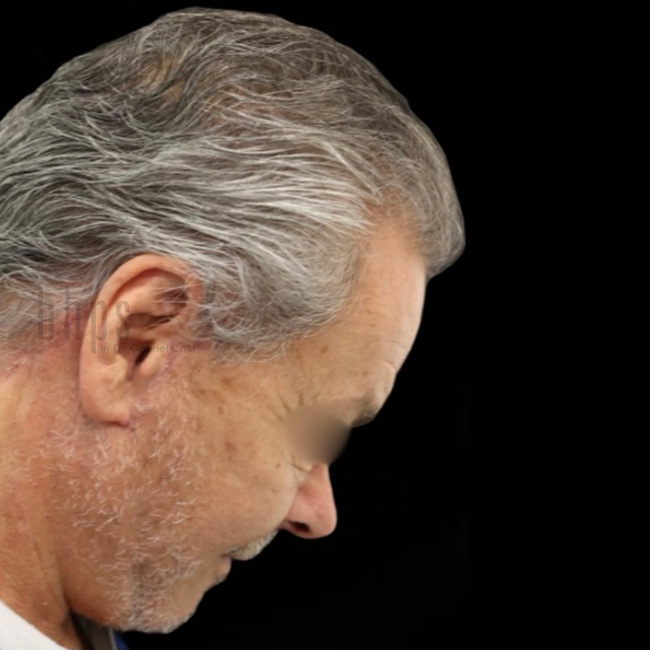 Neck Lift Patient After - 2