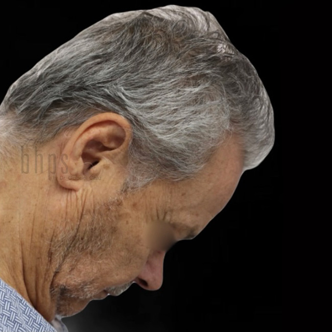 Neck Lift Patient Before - 2