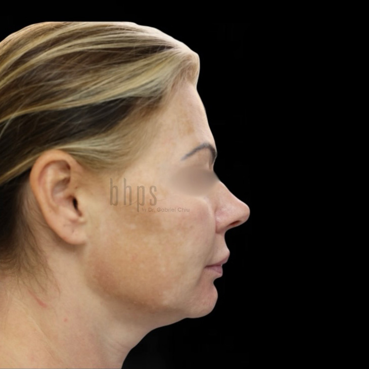 Neck Lift Patient Before - 1