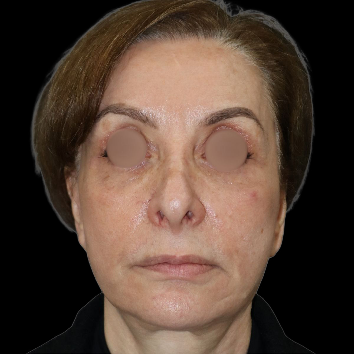 Case--7529 | After Facelift