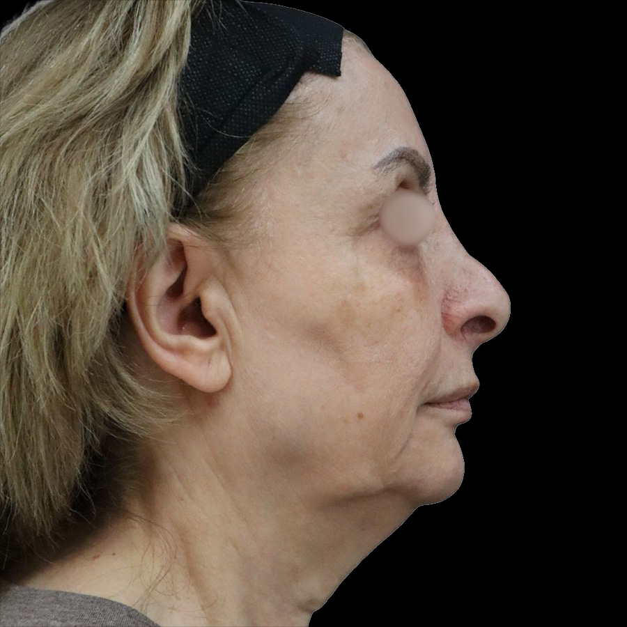 Case--7529 | Before Facelift 2