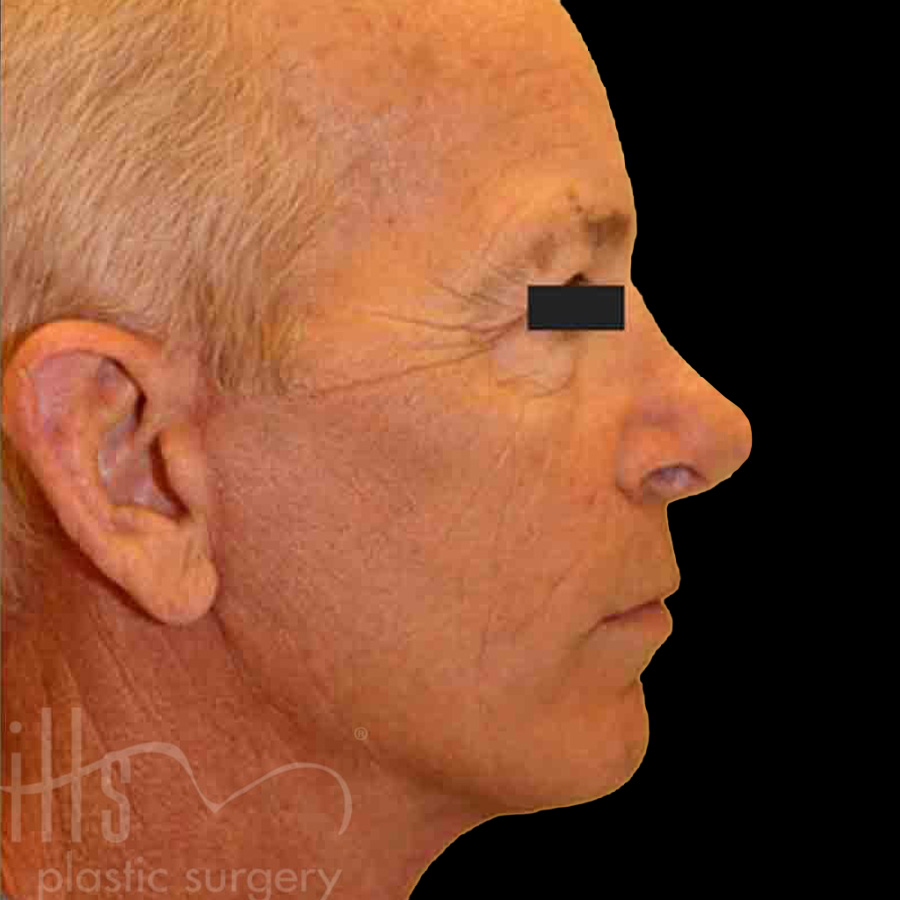 Case--2228 | After Face