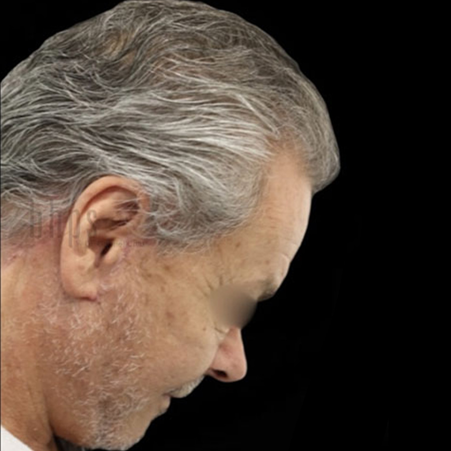 Case--3251 | After Face