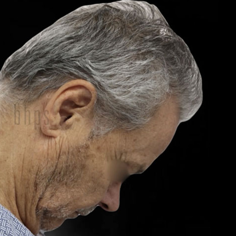 Case--3251 | Before Face