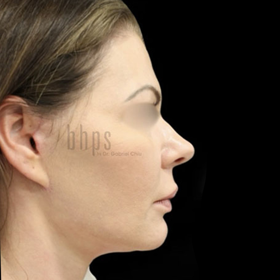 Case--3331 | After Face