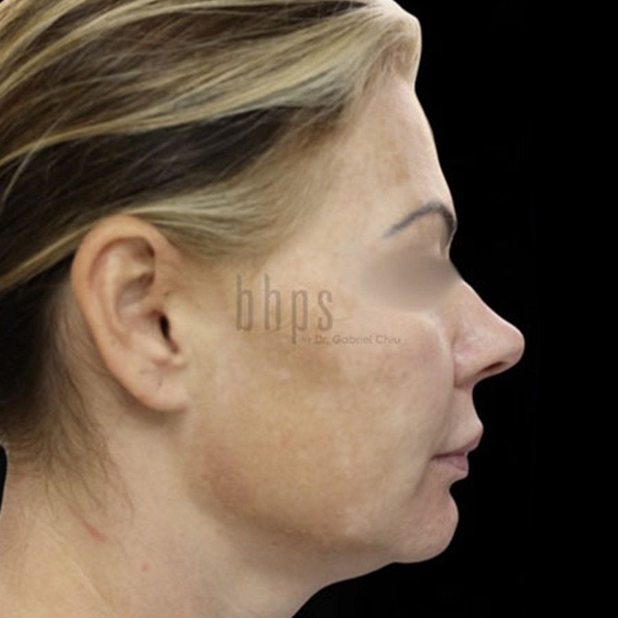 Case--3331 | Before Face