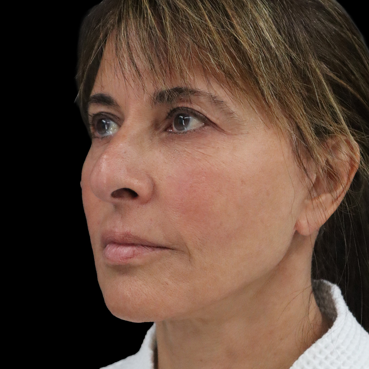 Facelift Patient After - 1
