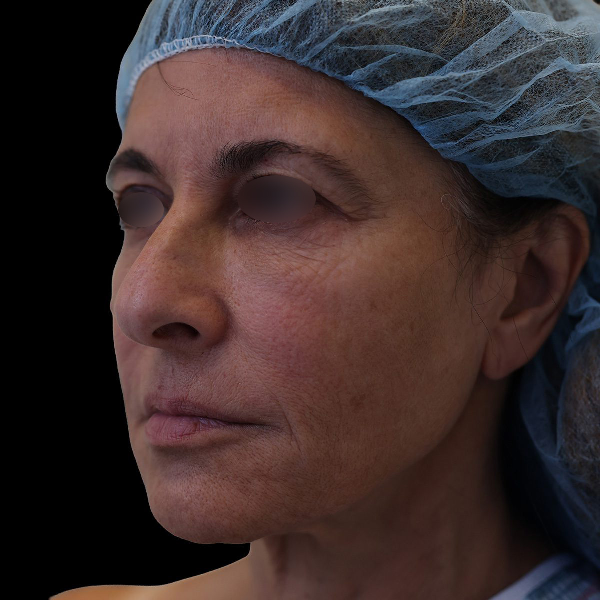 Facelift Patient Before - 1