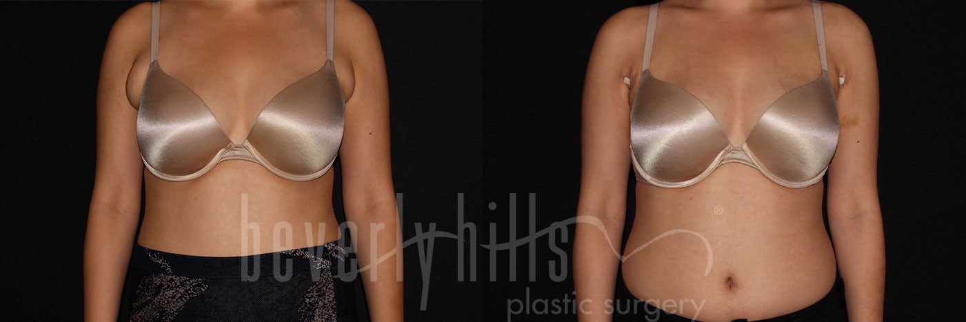 Excess Breast Fat Removal Patient 01 Before & After