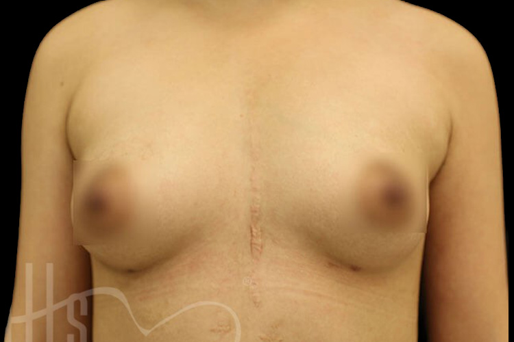 Case--7468 | After Fat Transfer to Breasts