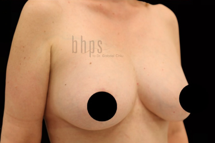 Case--8408 | After Fat Transfer to Breasts 3