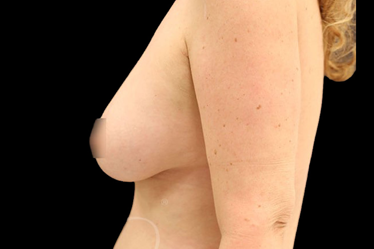 Case--8408 | After Fat Transfer to Breasts 5