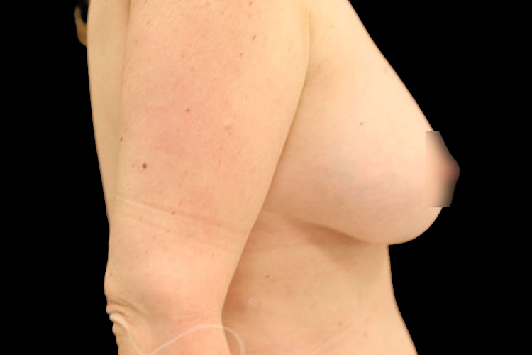 Case--8408 | After Fat Transfer to Breasts 4