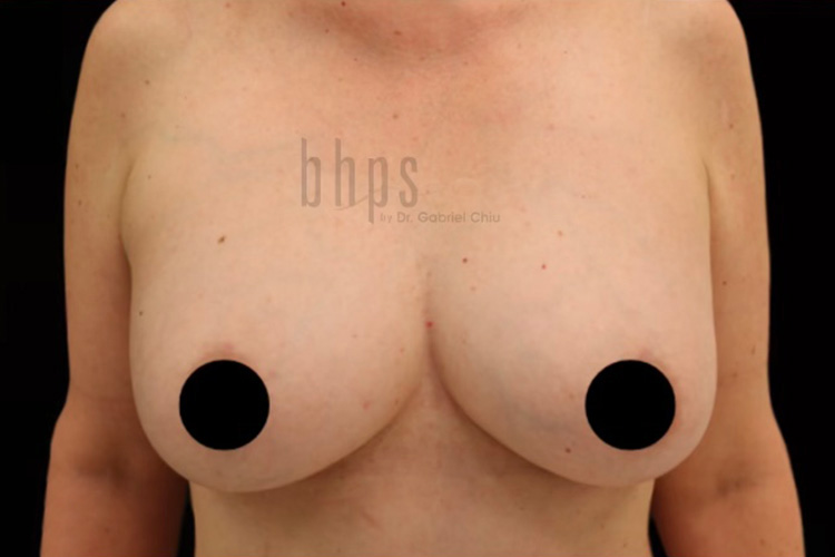 Case--8408 | After Breast