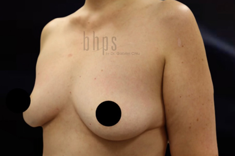 Case--8408 | Before Fat Transfer to Breasts 2