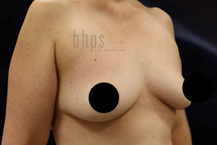 Case--8408 | Before Fat Transfer to Breasts 3